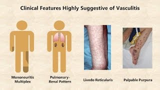 VASCULITIS  VASCULAR PATHOLOGY  Recap [upl. by Ilyssa]