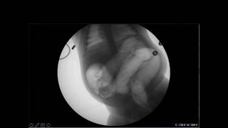 Pediatric Emergency POCUS Targeting Intussusception [upl. by Rachelle]