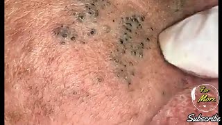 Dr Pop  Deep Blackheads in old Skin removing amp treatment 2020 Part 4 HD [upl. by Quirita]