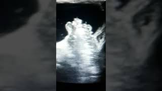 Ultrasound guided Hydrostatic Reduction of Intussusception [upl. by Laing789]