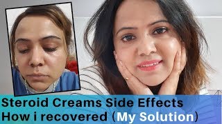 How I Recovered From Steroid cream Side Effects  My Experience  Stop using Hydroquinone [upl. by Gerkman]