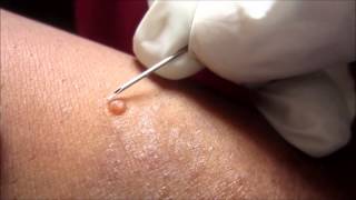 Removing H P Body From Molluscum Contagiosum [upl. by Nivri]