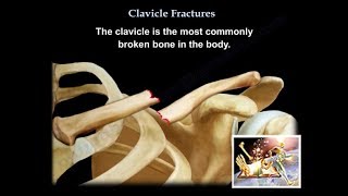 Clavicle Fractures  Everything You Need To Know  Dr Nabil Ebraheim [upl. by Karim253]