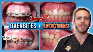 Braces Overbite Treatment BEFORE amp AFTER [upl. by Haley]