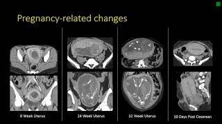 Gynecologic Radiology Anatomy [upl. by Abbot]