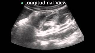 Pediatric Intussusception [upl. by Enirehtak]