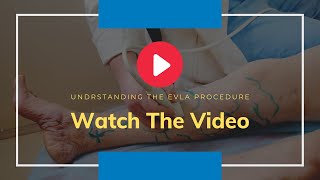 Say Goodbye to Varicose Veins EVLT Minimally Invasive Surgery Explained [upl. by Lienahs689]