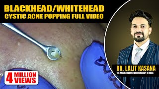 BLACKHEADWHITEHEADCYSTIC ACNE POPPING FULL VIDEO [upl. by Bove579]