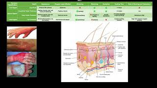 Classifying Burns EXPLAINED [upl. by Siramad]