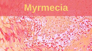 Deep Palmoplantar Wart Myrmecia  Pathology mini tutorial [upl. by Roxie]