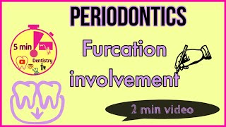 FURCATION INVOLVEMENT  Glickmans classification in 2 minutes  Periodontics [upl. by Tillinger]