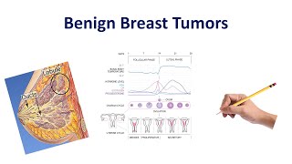 Benign Breast Conditions  USMLE COMLEX NCLEX [upl. by Solraced128]