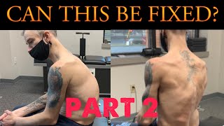 20 mins Posture Routine for Kyphosis Rounded Upper Spine [upl. by Mitran46]