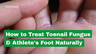 Athletes Foot Fungus BEST Home Remedies amp Treatment [upl. by Ynot]