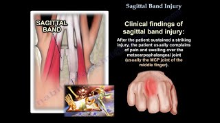 Sagittal Band Injury  Everything You Need To Know  Dr Nabil Ebraheim [upl. by Eramat]