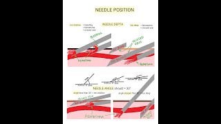 Venipuncture  How to Position a Needle [upl. by Calie225]