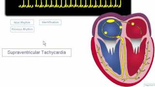 ECG Rhythm Review SVT Atrial Fibrillation Atrial Flutter [upl. by High239]