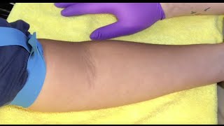 Tips For Locating Difficult Veins [upl. by Giff]