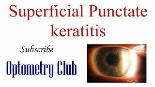 Superficial Punctate Keratitis Introduction Diagnosis and Treatment [upl. by England751]